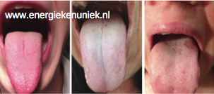 Energiek en Uniek - tongdiagnose